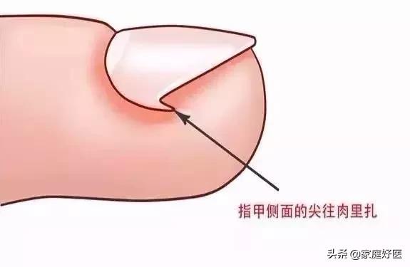 甲沟炎穿什么鞋袜最合适 (甲沟炎恢复了穿凉鞋还会复发吗)