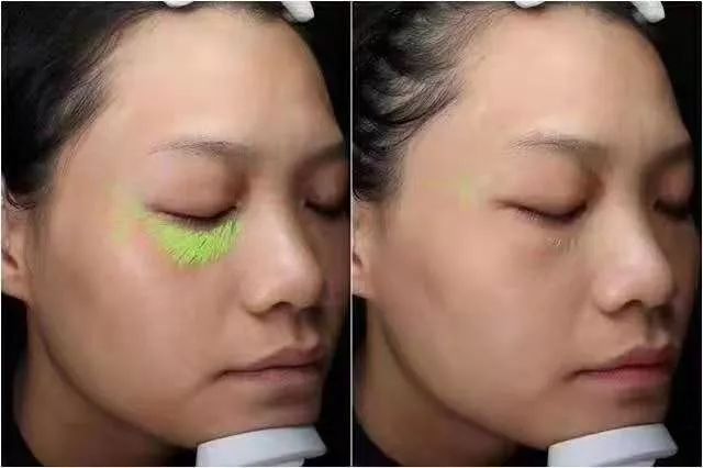 人生第一次医美感受,伊肤泉微针小白瓶