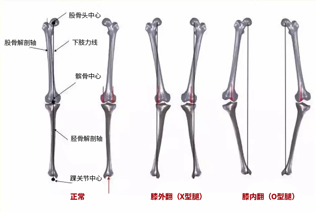 骨关节炎痛风和类风湿都有何症状,痛风关节严重畸形患者能活多久