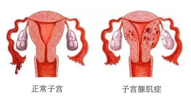 子宫腺肌症吃什么中药,子宫腺肌症是什么意思