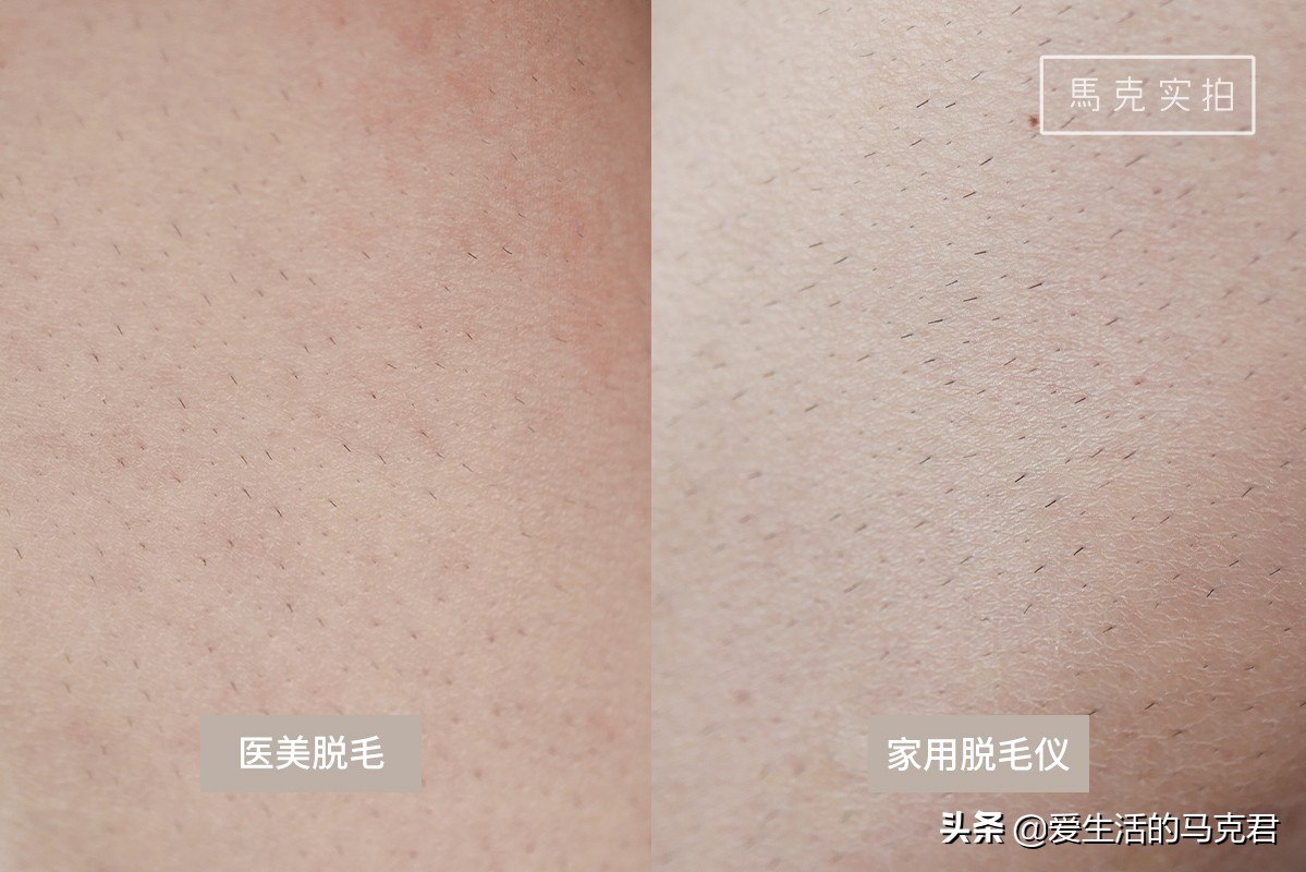 家用脱毛仪哪个牌子脱毛效果最好,家用脱毛仪是不是智商税