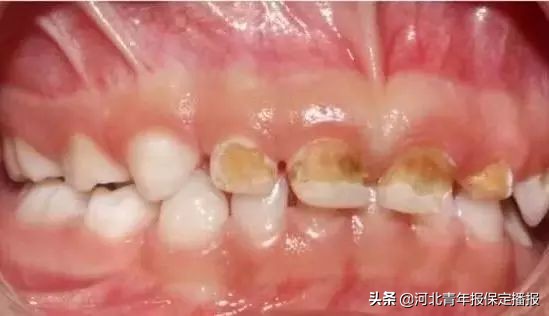 广大口腔公益种牙补贴,领取口腔优惠