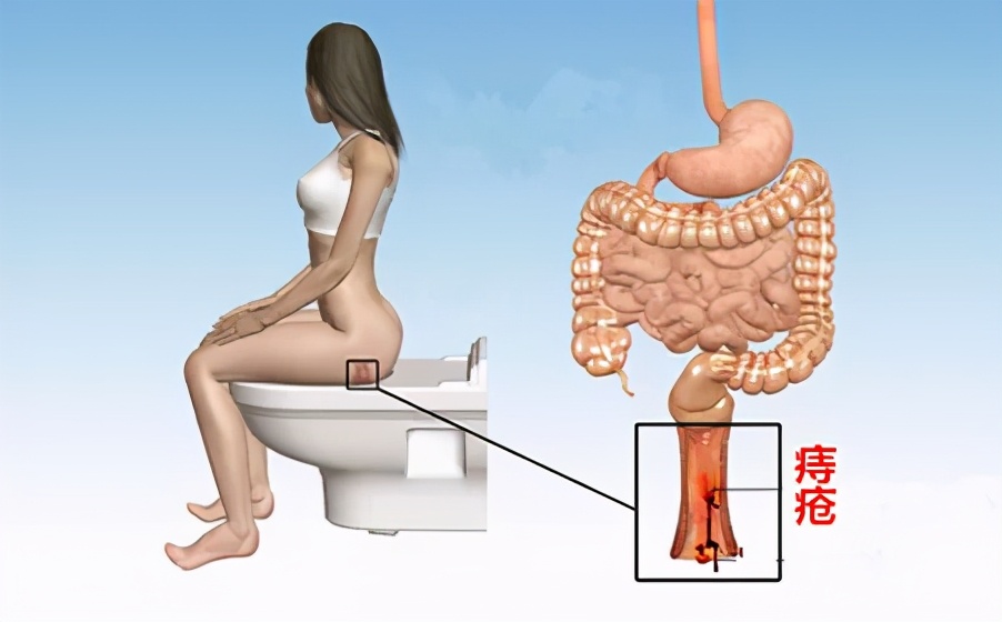 痔疮老是复发有哪些中药可以调理,痔疮怎么老是复发