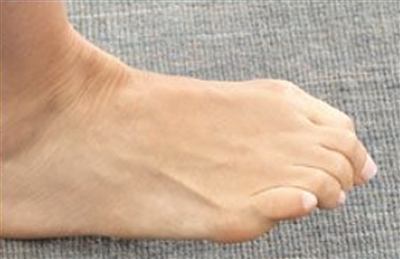 脚趾为什么那么不灵活,脚踝扭伤后恢复后脚趾头不灵活