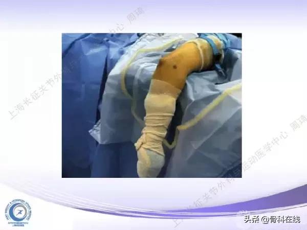 肘关节镜手术后引流,肘关节镜微创手术