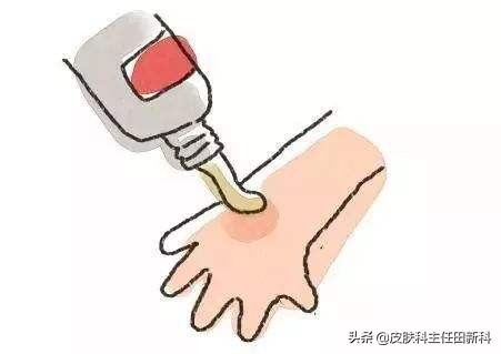 皮肤病用激素药的副作用,皮肤病滥用激素危害多