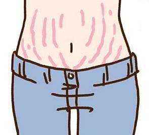 生长纹肥胖纹之前有什么反应,生长纹肥胖纹是长什么样