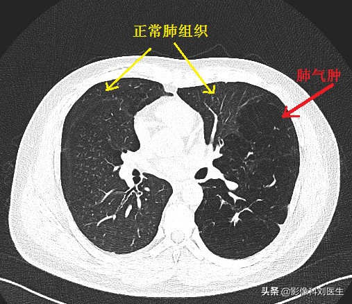 肺气肿治疗权威专家,老年人肺部疾病有哪些