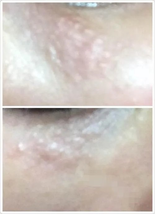 护肤界有名的难缠小妖精,现在搞定它