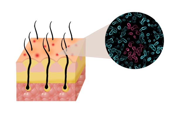 头皮上出小脓包出油,头皮出油起疙瘩有头屑