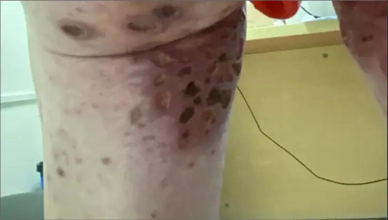 得了湿疹,得了湿疹身上的伤就没好过