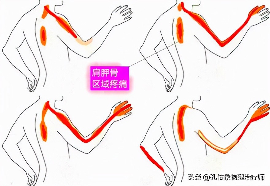 常手麻需警惕,常觉得手麻