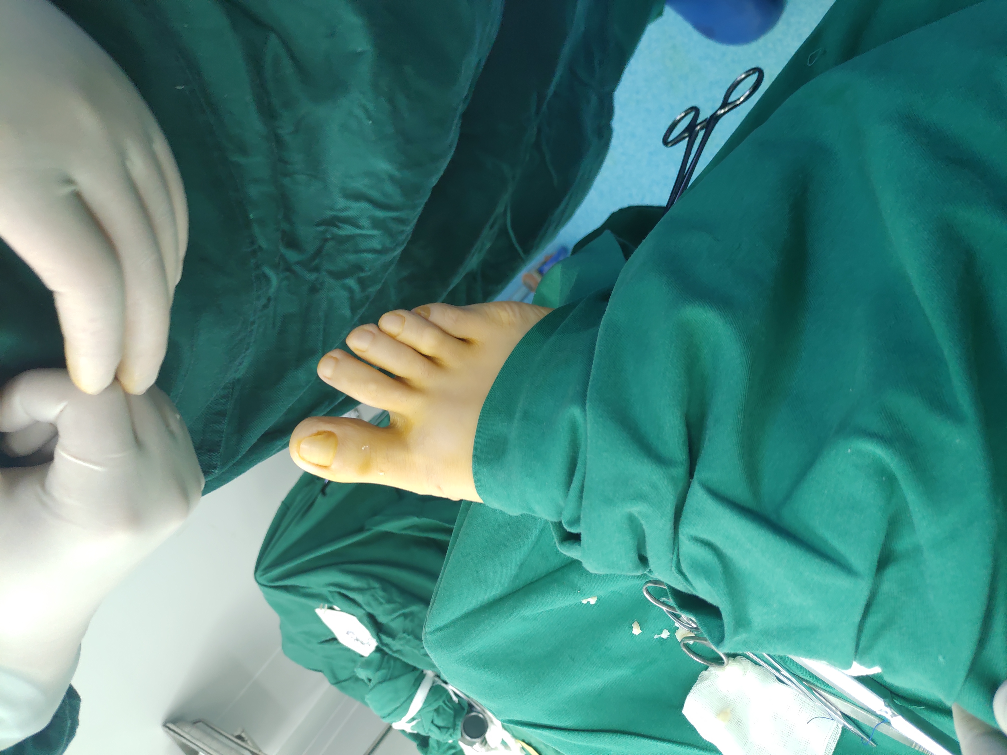 20岁男拇外翻,年轻小伙子拇外翻好大