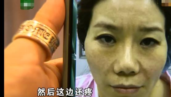 脸部填充手术案例,开腹手术美容线线头露出来怎么办