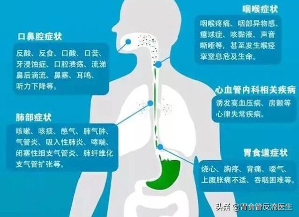 反酸，烧心，腹胀，嗳气，心口痛关于反流你还应该知道这些