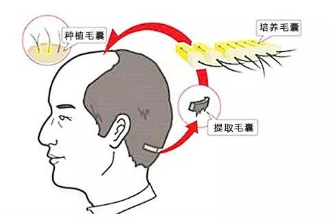 头发种植手术是如何种植的,头发种植利弊有哪些呢