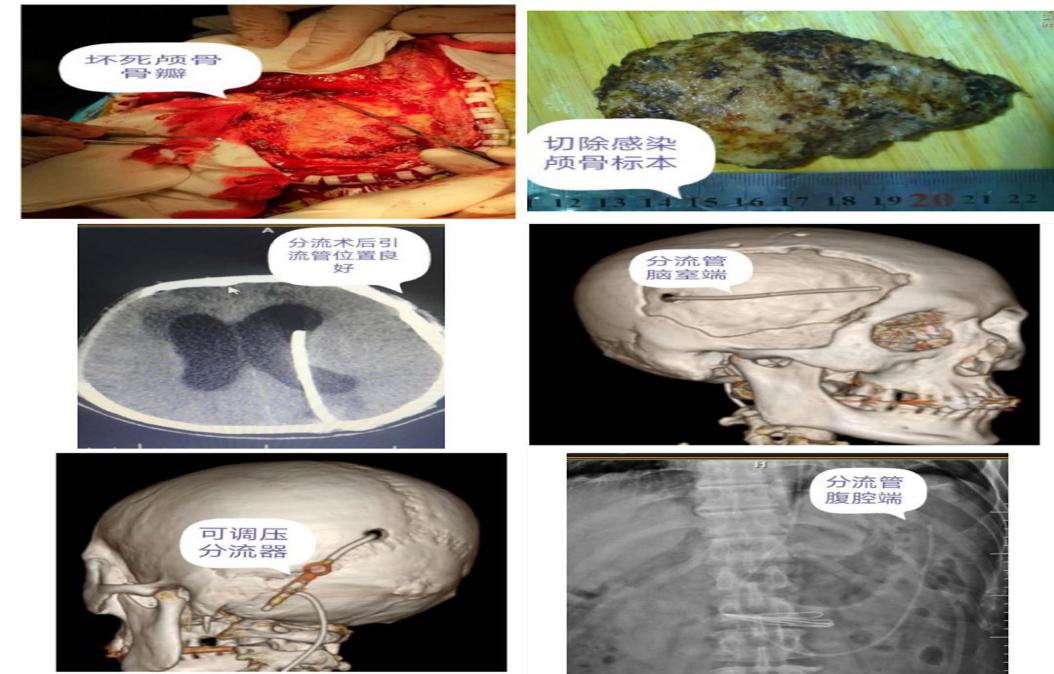 神经外科脑积水,沈北中心医院外科