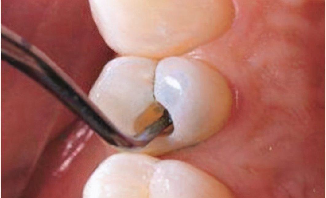 补牙后敏感遇冷热疼痛,补牙后牙齿敏感怎么处理最好