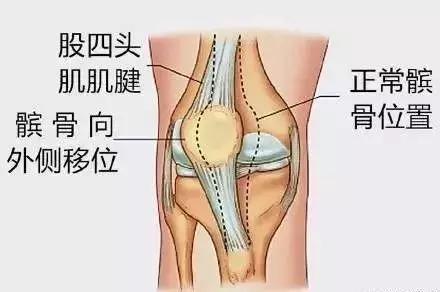 髌骨脱位了怎么办？！康复练习法有哪些（图文解说）