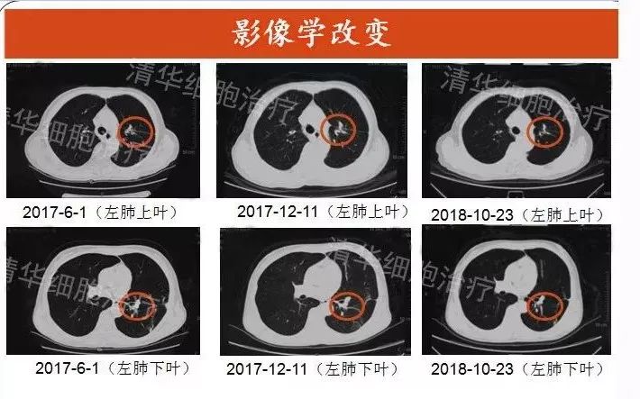 nkt治疗对什么肿瘤有效,nkt治疗适合哪种癌症