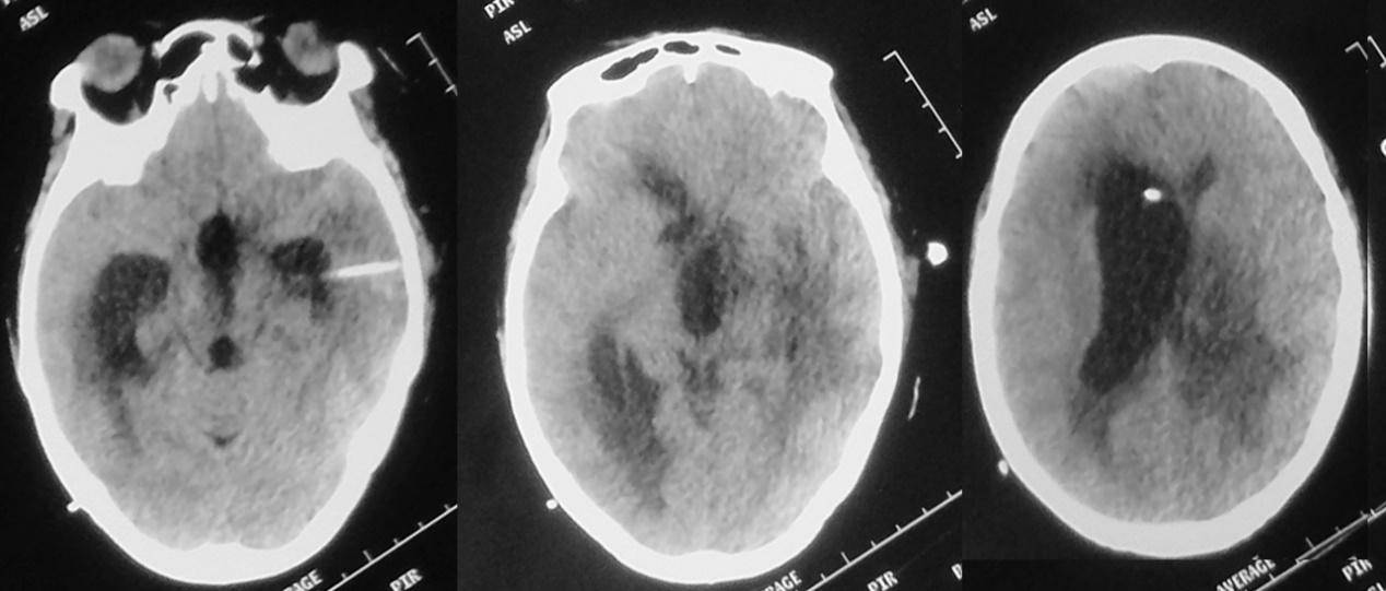 脑脓肿合并脑膜炎需要手术吗,脑脓肿进入左侧脑室严重吗