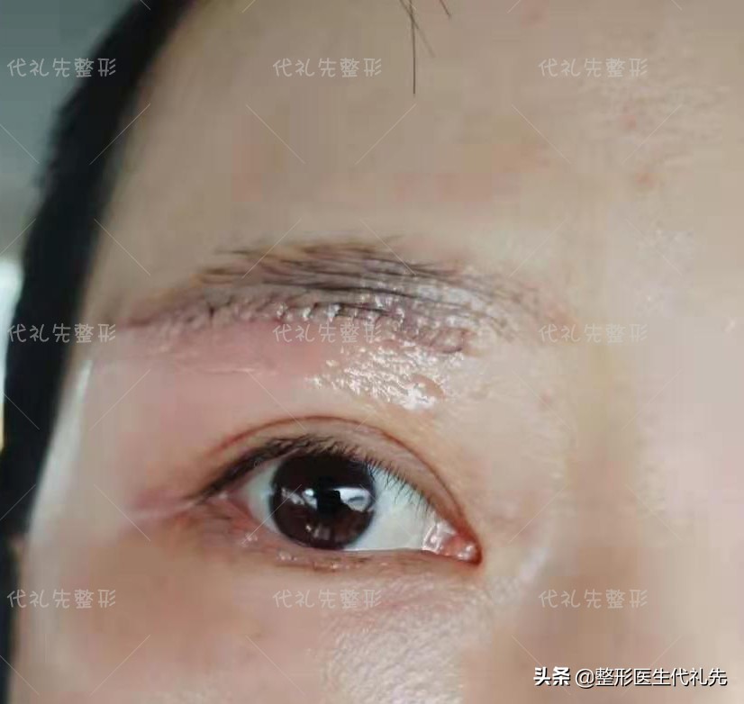 提眉手术疤痕凹凸不平,提眉手术后红肿怎么办