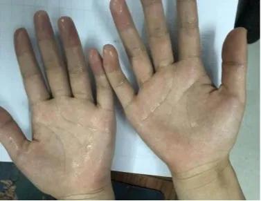 手汗症中医诊疗方案,手掌多汗症怎么治疗