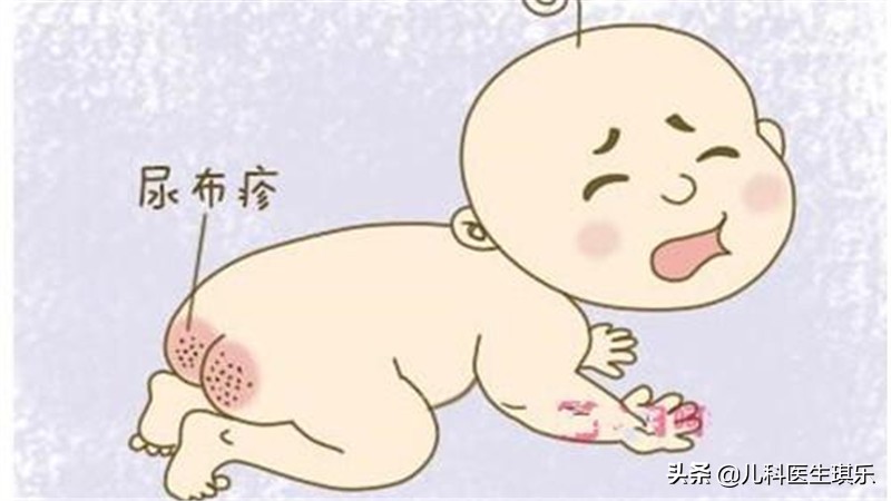 宝宝尿布疹该如何护理,宝宝尿布疹怎么治疗预防