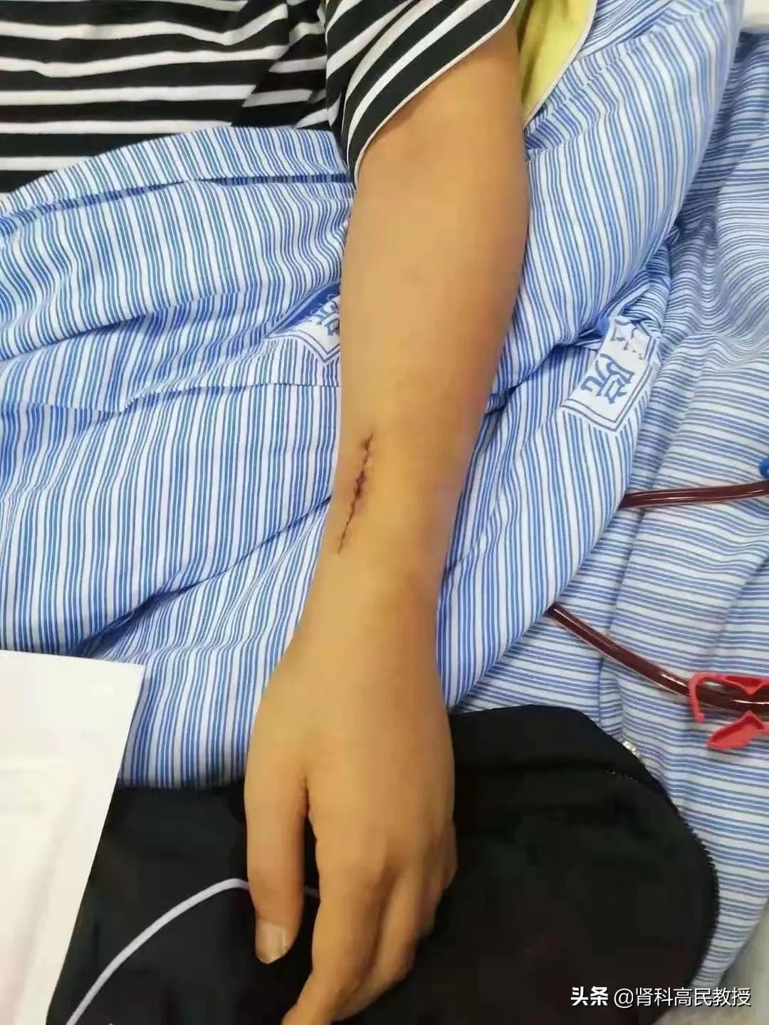 尿毒症手臂造瘘,乳腺癌十年胳膊肿了会有危险吗