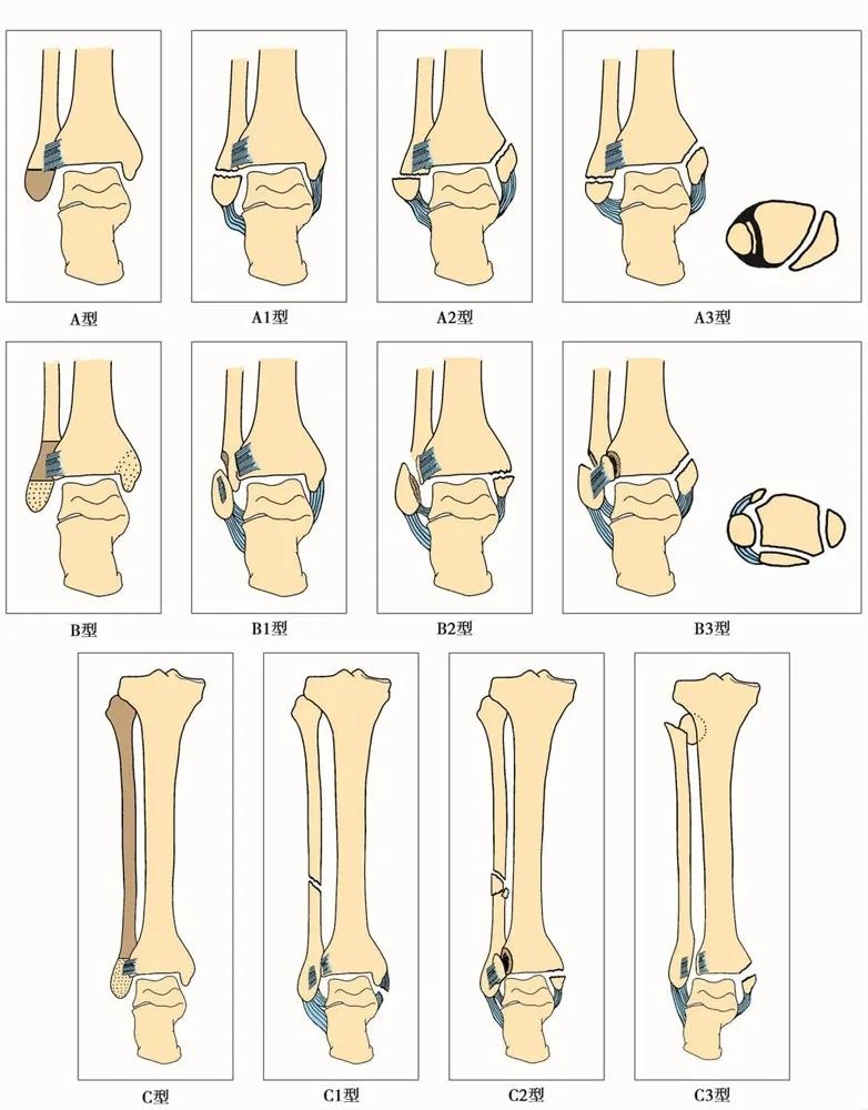 儿童踝关节骨折分型,收藏踝关节骨折的常见分型