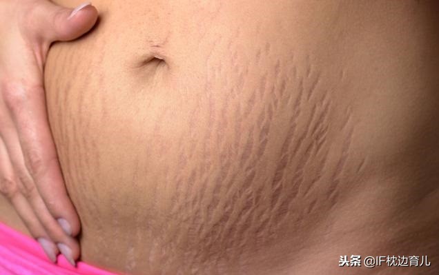 产后如何消除妊娠纹最有效的方法,产后怎么去妊娠纹最有效方法