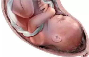 怀孕最怕脐带打结,孕期最怕胎儿脐带绕颈怎么避免