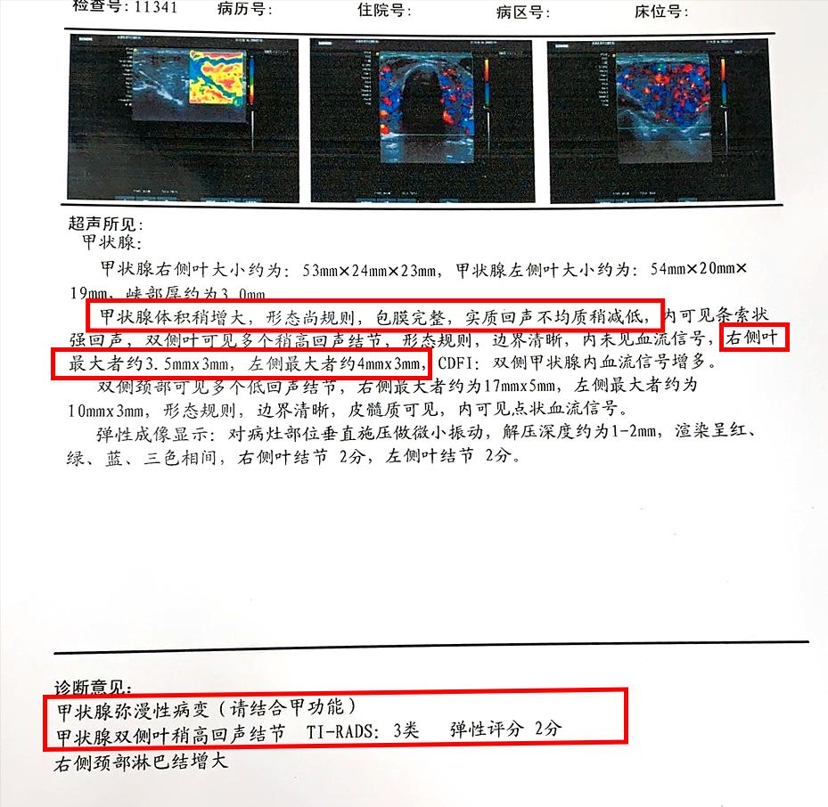 真的是药三分毒吗,甲亢的假象