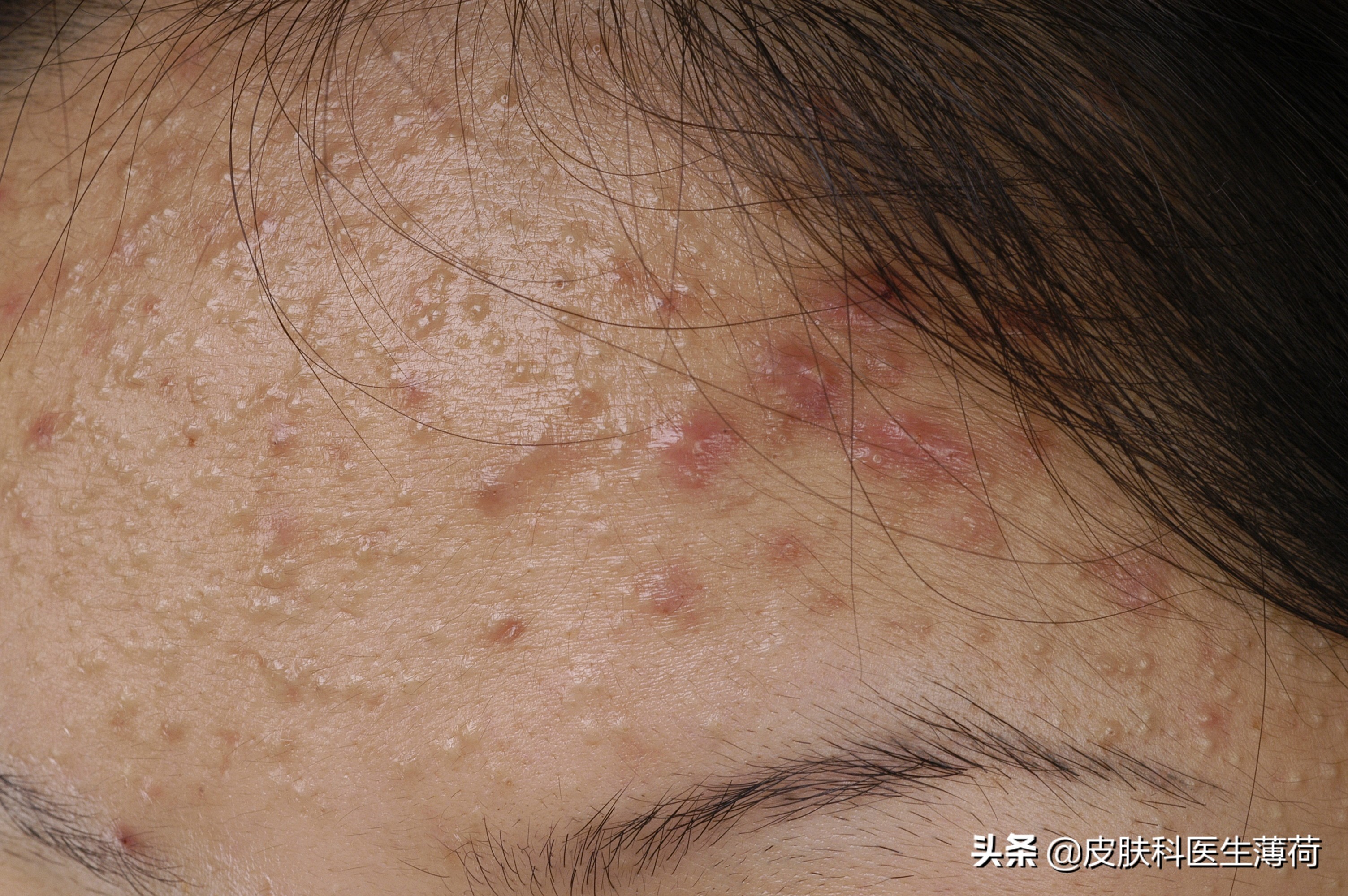 皮肤科医生怎么祛痘痘,皮肤科中医专家教你快速祛痘