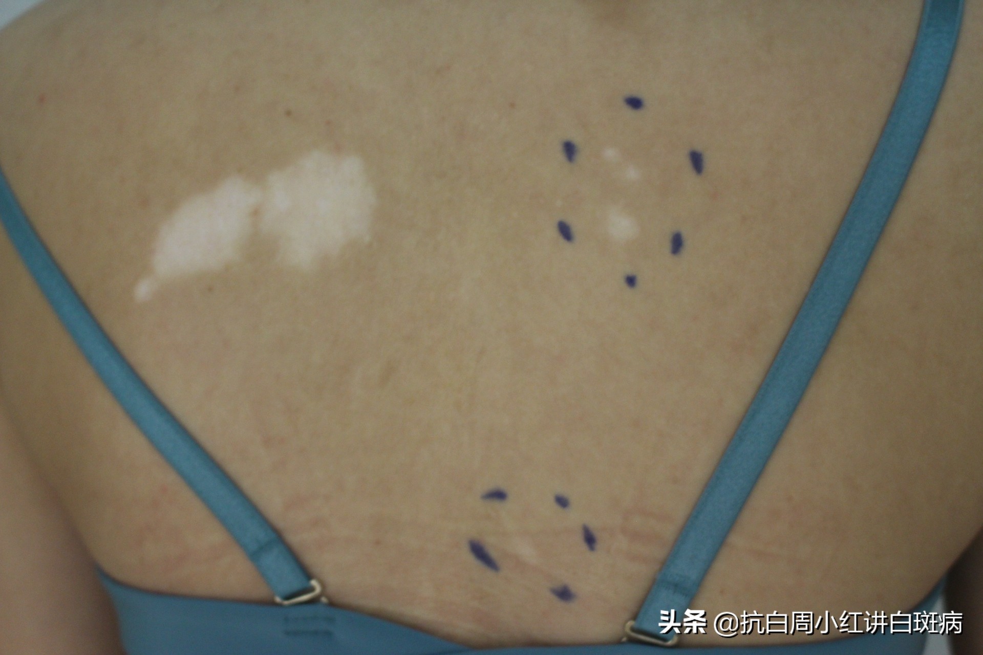 白癜风患者治好的全过程,白癜风治愈患者分享痊愈经验