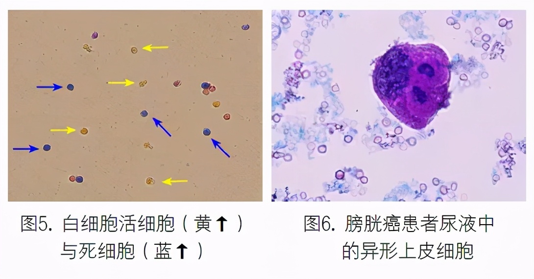 尿液有形成分分析的应用进展,尿液染色方法
