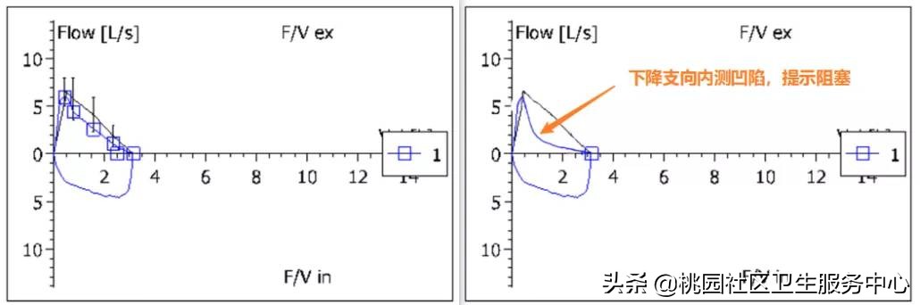肺功能报告解读,怎样正确解读肺功能报告