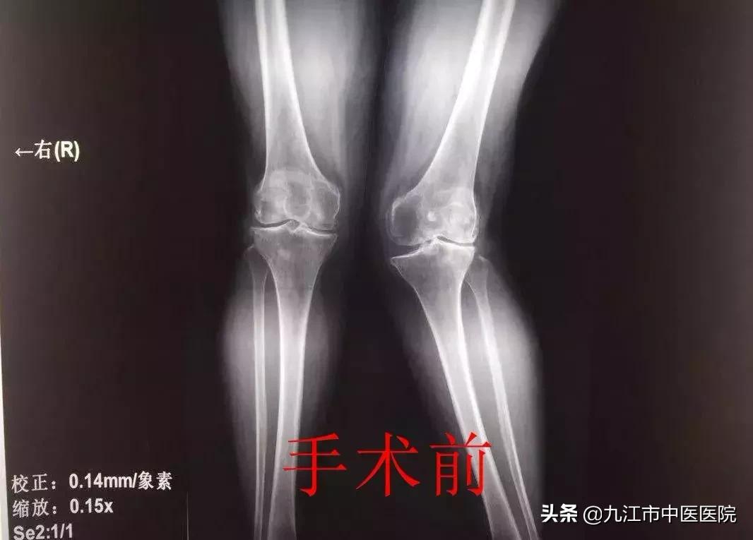 膝外翻畸形,膝外翻畸形伴屈曲畸形