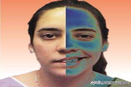 非典型面肌痉挛如何治疗,面肌痉挛最好的治疗方法