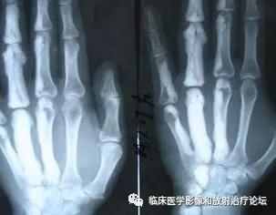 蜡泪样骨病发展缓慢,蜡泪样骨病影像表现