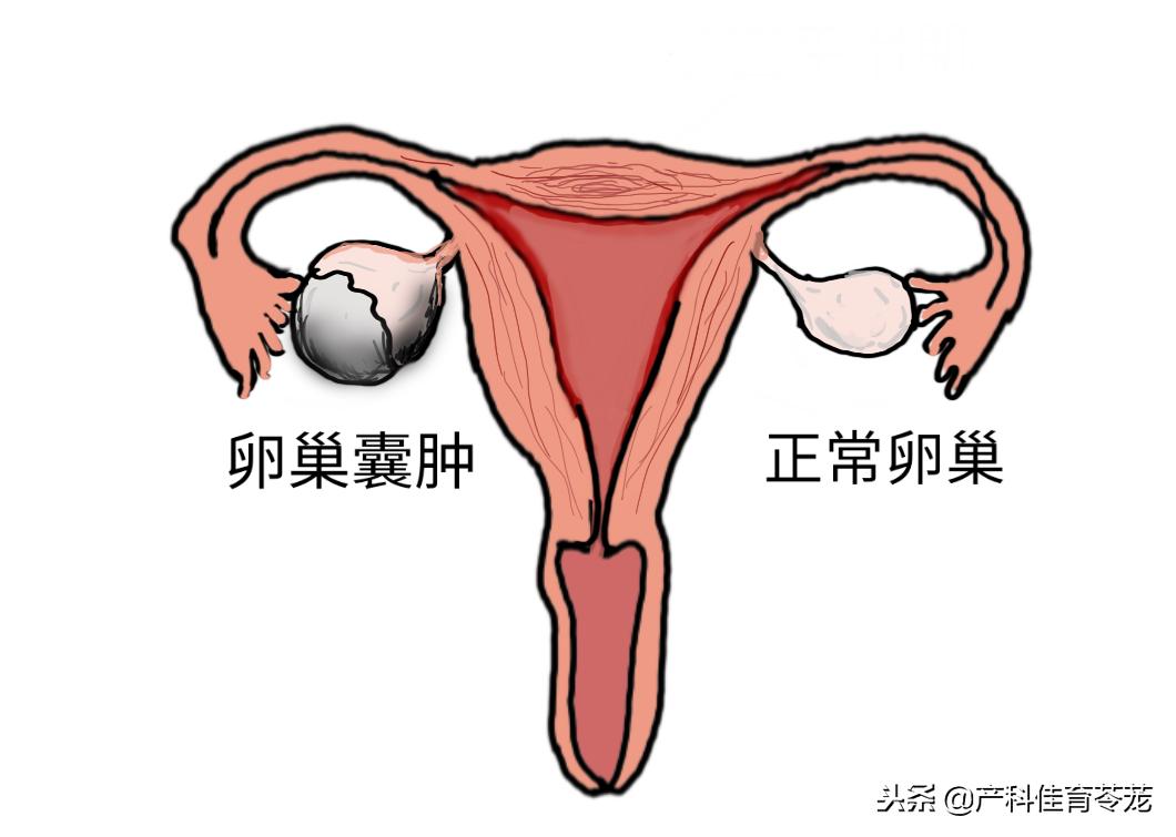 卵巢囊肿是黄体囊肿吗,盆腔囊肿是卵巢囊肿吗