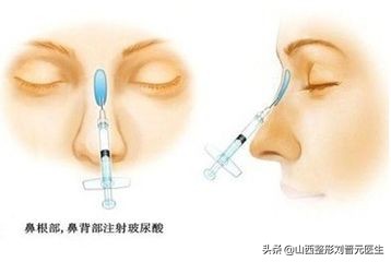 捏鼻子能让鼻梁变高,婴儿捏鼻梁变高真的吗