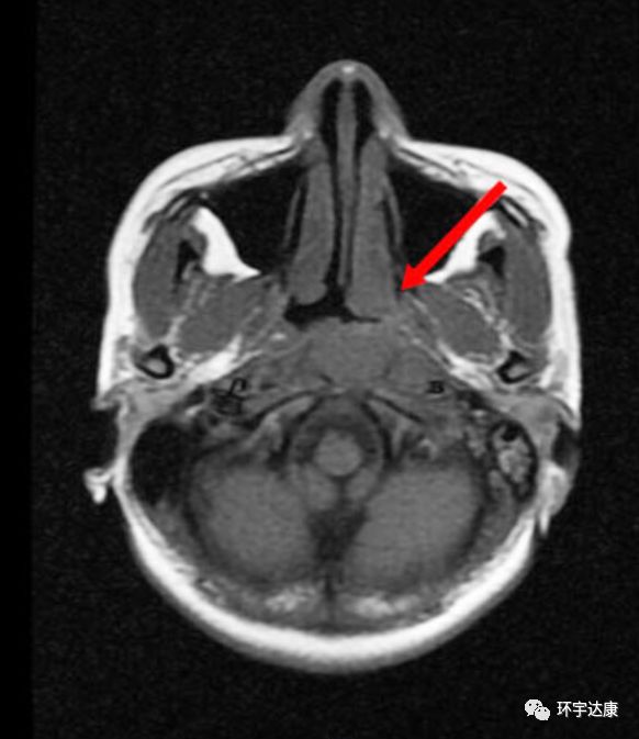 全国治疗鼻咽癌排行榜,鼻咽癌全球发病率最高的地区是