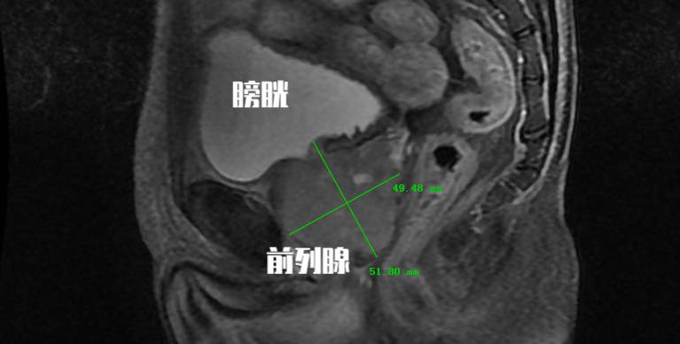 中医治疗前列腺增生什么药最有效,中医治疗前列腺增生多久能见效