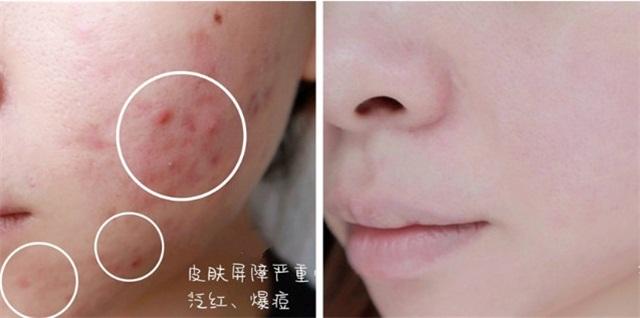 敏感肌激素脸护肤品推荐,分享敏感肌修复面霜