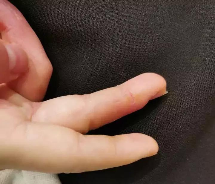 手上脱皮是什么真菌,手上脱皮真菌感染抹什么药膏好