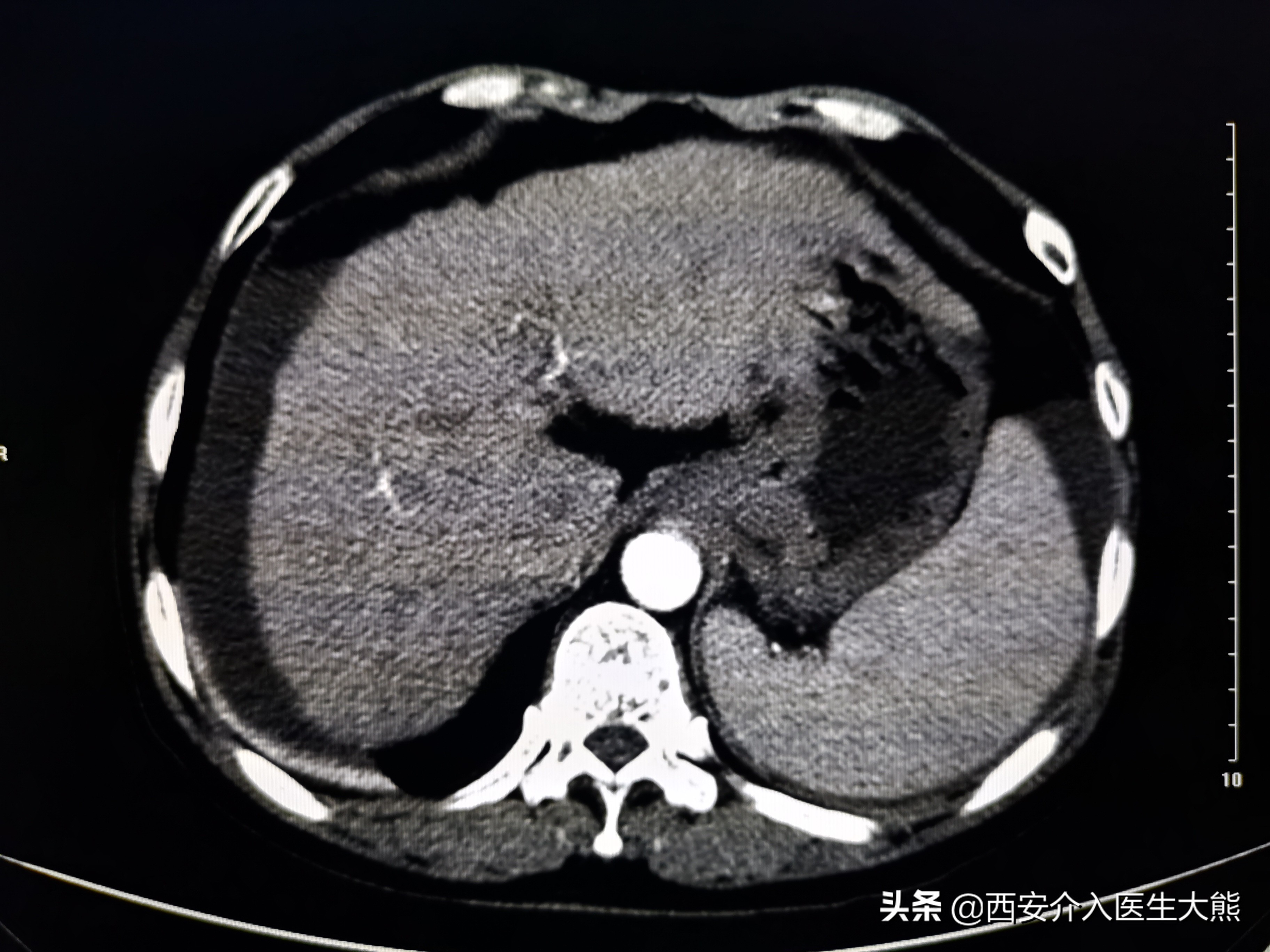 肝硬化消化道出血的病例护理讨论,肝硬化引起的消化道出血如何治疗