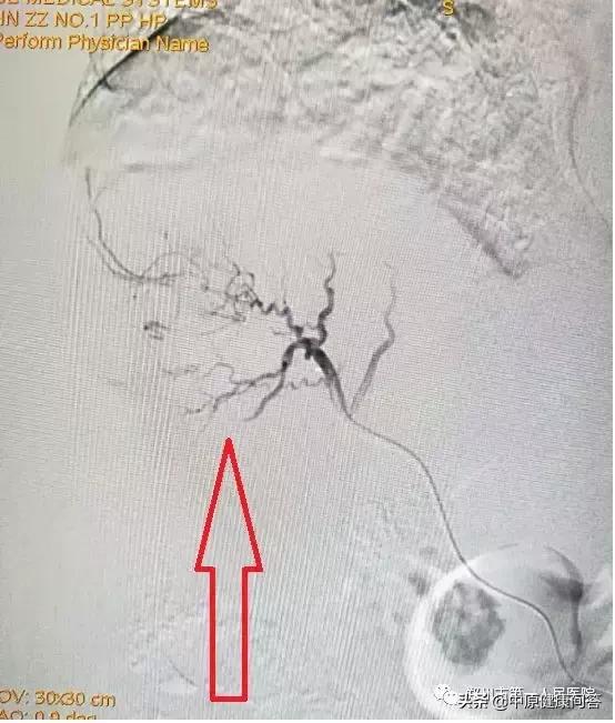 肝癌黄疸可以介入栓塞和灌注,肝癌栓塞介入手术后尿液发红