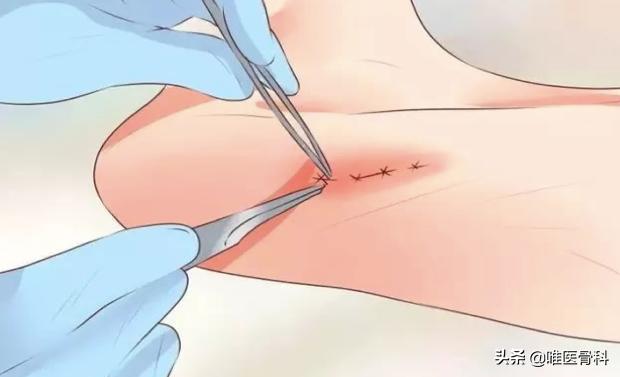 足底筋膜炎可以快走吗,足底筋膜炎快走