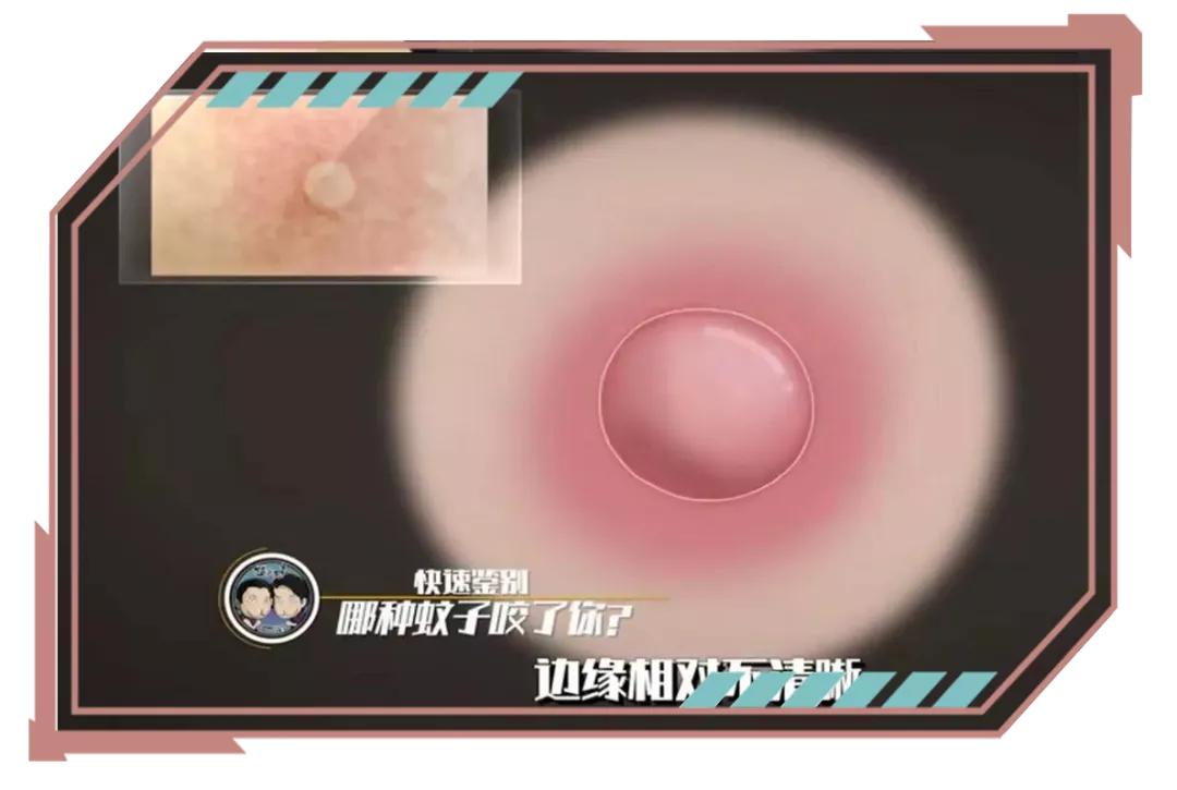 同样是被咬，为啥你的包又痒又大？